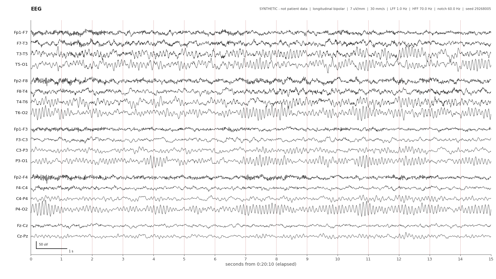 Adolescent · awake. Synthetic EEG with channel labels, time grid and calibration.