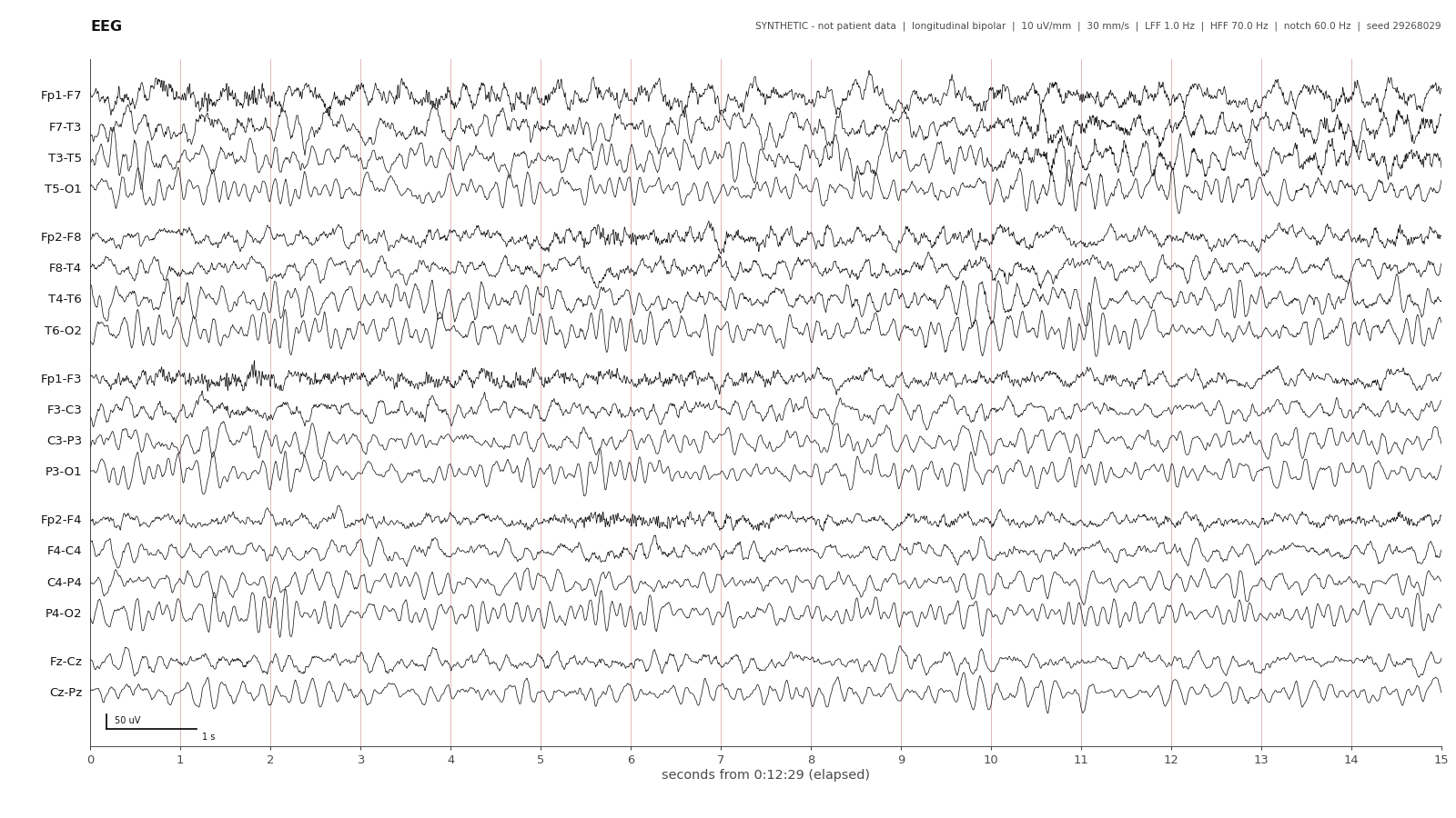 Eight years · awake. Synthetic EEG with channel labels, time grid and calibration.