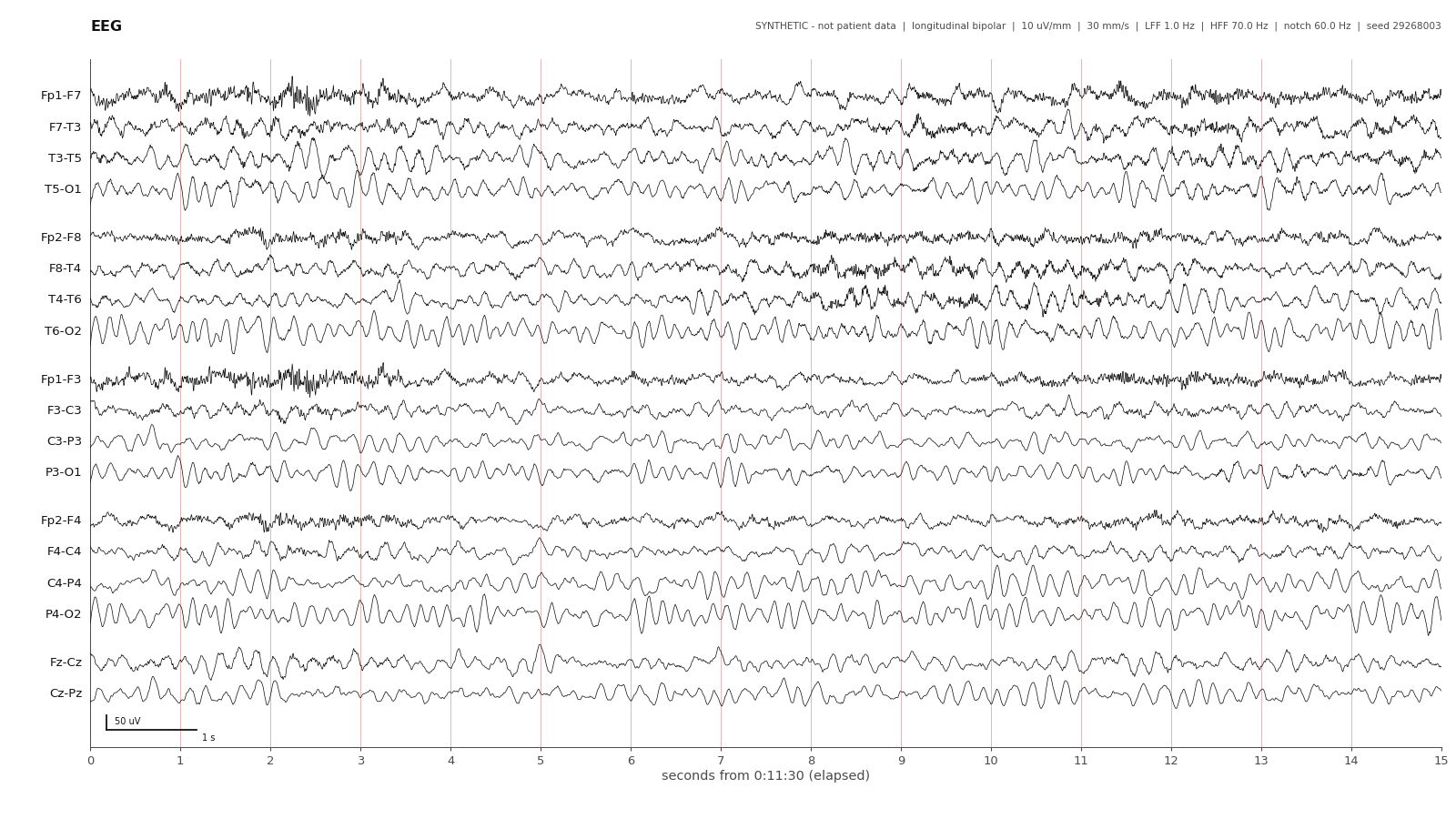 Two years · awake. Synthetic EEG with channel labels, time grid and calibration.